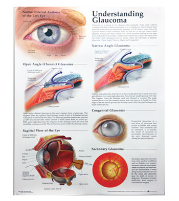 Understanding Glaucoma