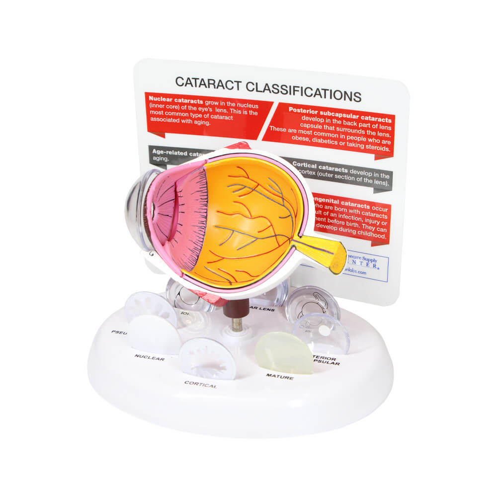 Cataract Eye Model - 2