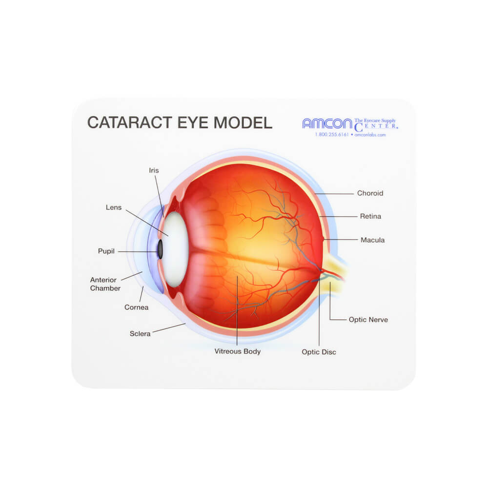 Cataract Eye Model - 5