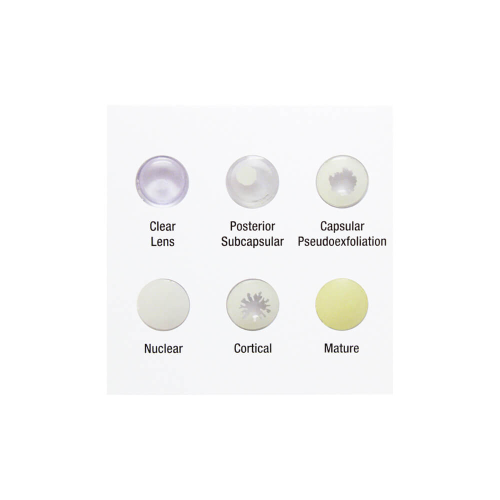 Cataract Eye Model - 6