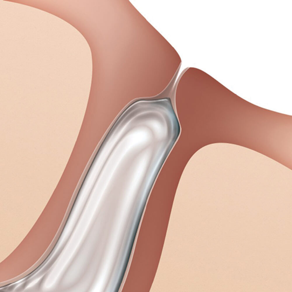 Form Fit® Hydrogel Intracanalicular Silicone Plugs - 1